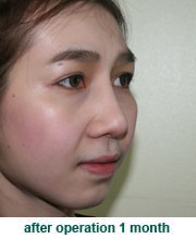 plastic_surgery_augmentation_rhinoplasty